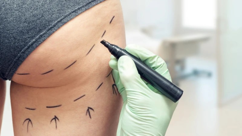 Por que Reino Unido faz ofensiva contra o 'Brazilian butt lift', procedimento para aumentar o bumbum