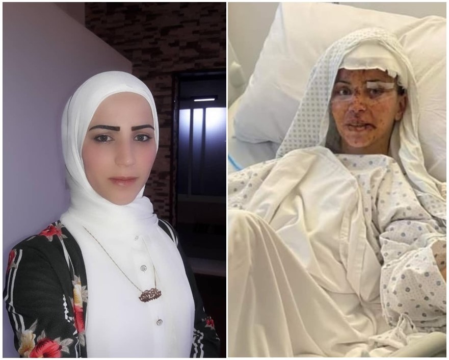 Brasileira ferida em bombardeio no Líbano tem melhora no estado de saúde, mas deve passar por novas cirurgias, diz família