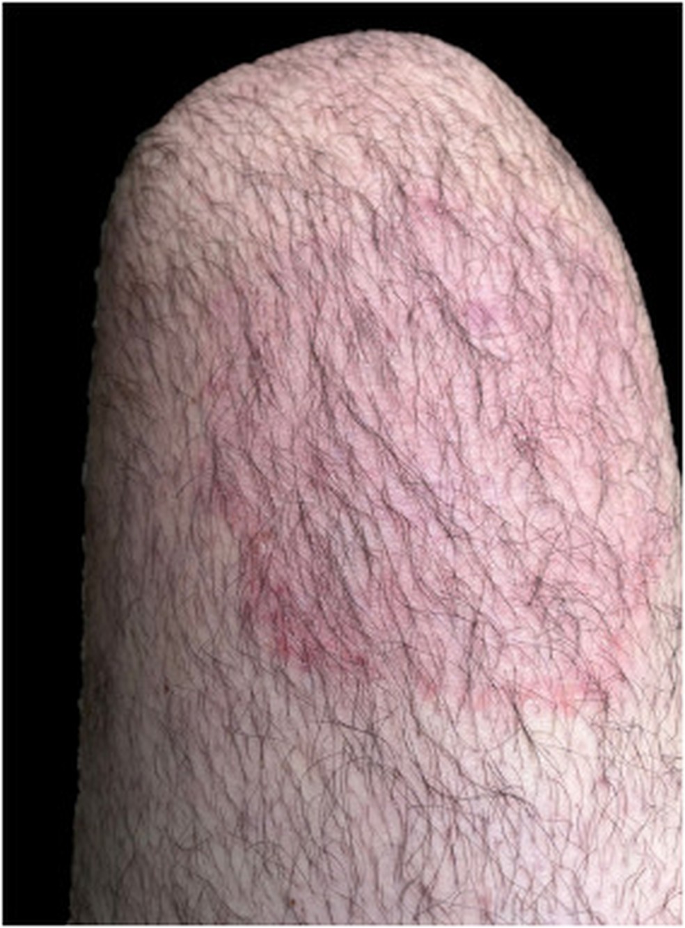 Mancha vermelha na perna de paciente diagnosticado no Brasil  Foto: Veasey et al., 2025/Anais Brasileiros de Dermatologia