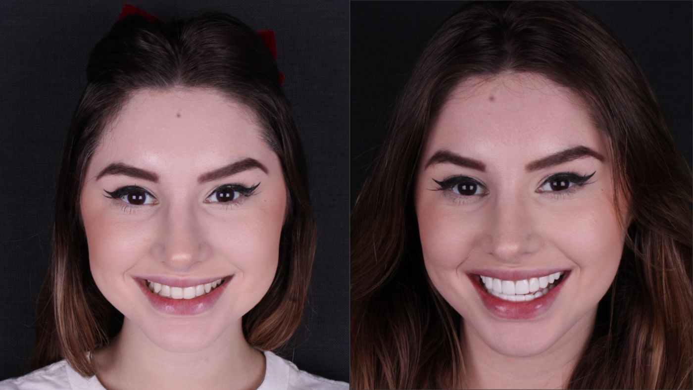 Facetas de Resina: O Segredo para um Sorriso Natural e Transformador 