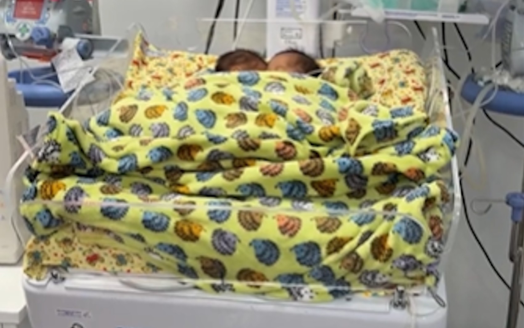 Bebês siameses que nasceram unidos pelo abdômen morrem em Goiás