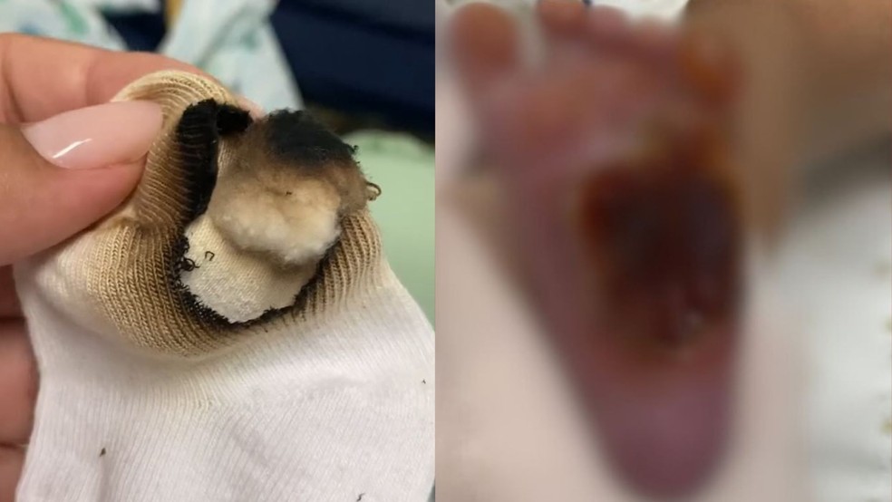 Bebê recém-nascido tem o pé queimado com algodão em hospital e precisa passar por cirurgia na Serra, Espírito Santo — Foto: Reprodução