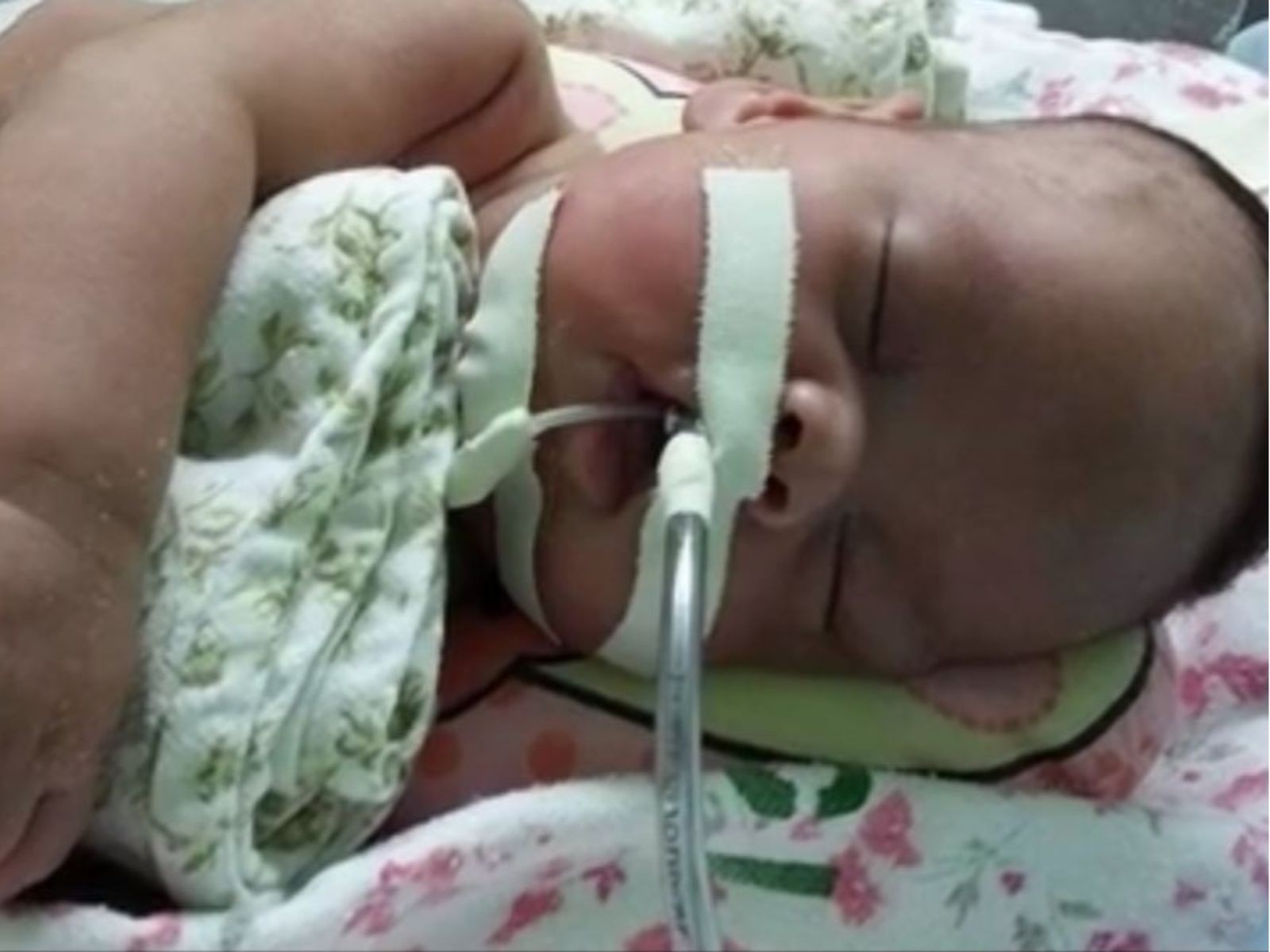 Mãe relembra luta de bebê que nasceu prematura e ficou 77 dias na UTI: 'É uma vitória'