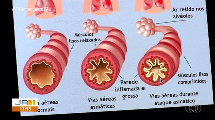 Período de estiagem pode agravar crises de asma