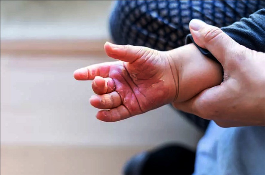 Amapá registra 15 casos de queimaduras em crianças de 1 a 4 anos em 2025; veja orientações