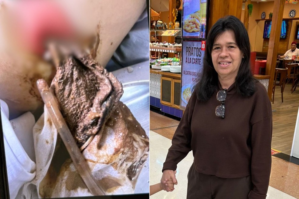 Pano foi retirado da barriga de Maria Luciene Vidal, por uma abertura onde fica a bolsa de colostomia que ela usa — Foto: Arquivo Pessoal