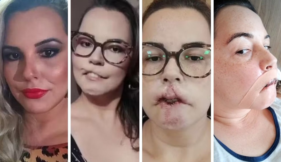 A influencer Mariana Michelini, de Matão, após harmonização com PMMA — Foto: Redes sociais/ Reprodução