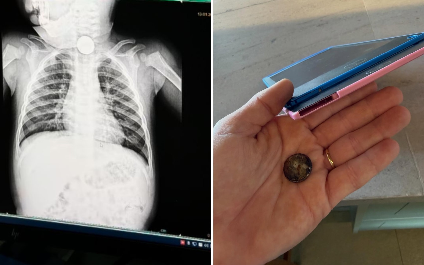 Mãe faz alerta após bebê engolir bateria de brinquedo em Goiás; vídeo