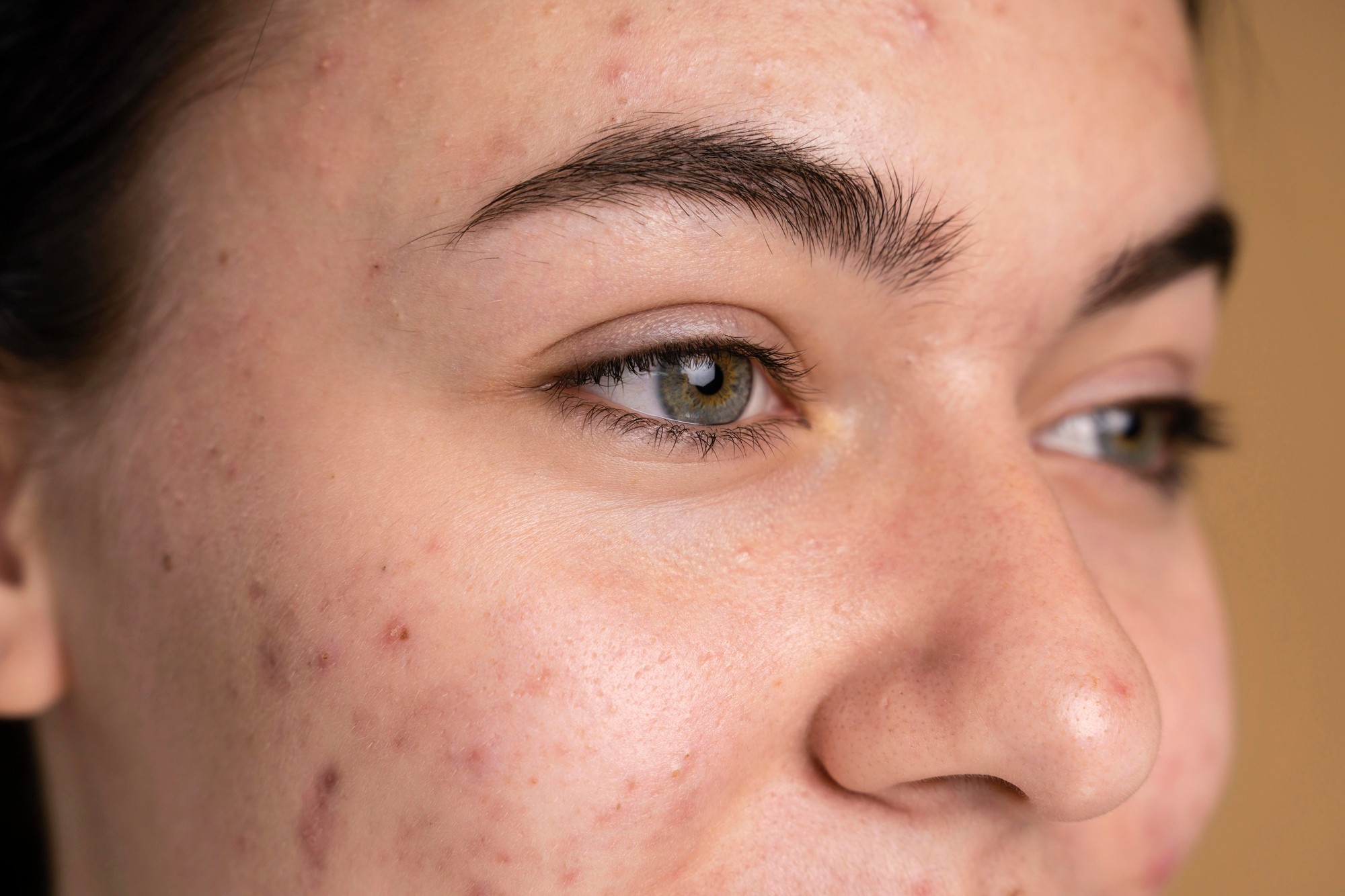 Roacutan: uso controlado contra acne