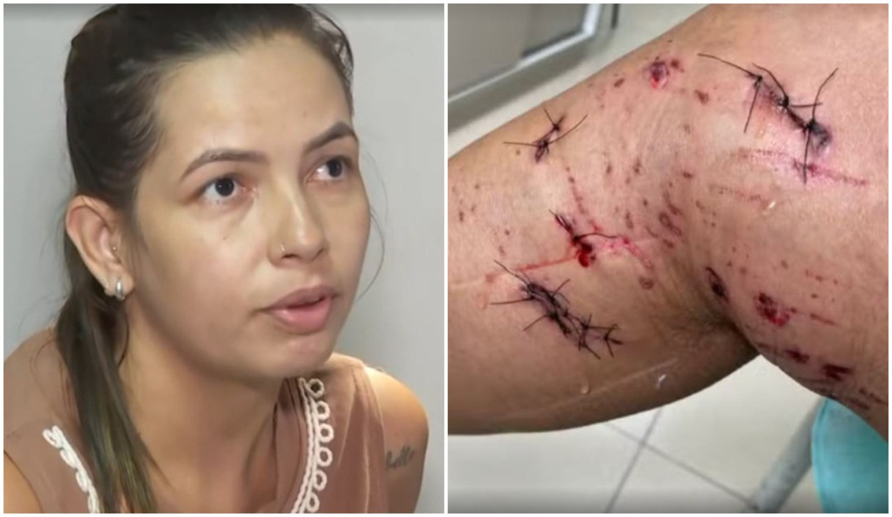 Cão pit bull ataca mulher em rua e vítima leva 21 pontos nas pernas no interior de SP: 'Traumatizada'