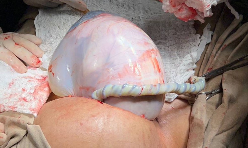 Caso raro de parto empelicado na Bahia tem bebê envolta por bolsa amniótica e irmã gêmea não — Foto: Lucas Henrique