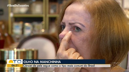 Câncer de pele representa 30% de todos os tumores malignos no Brasil