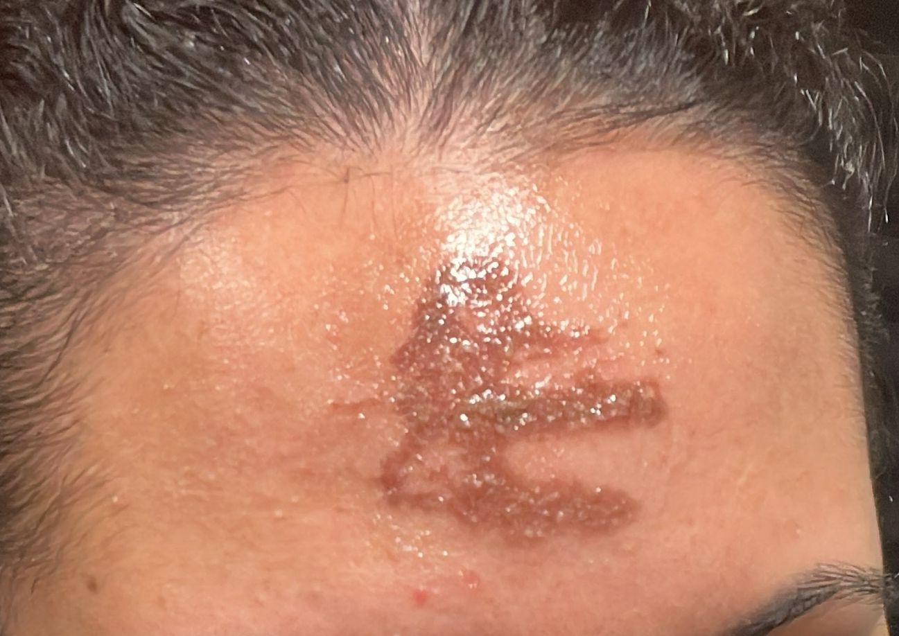 Fiéis sofrem ardência, reação alérgica e queimadura de 2º grau após contato com cinzas em missa