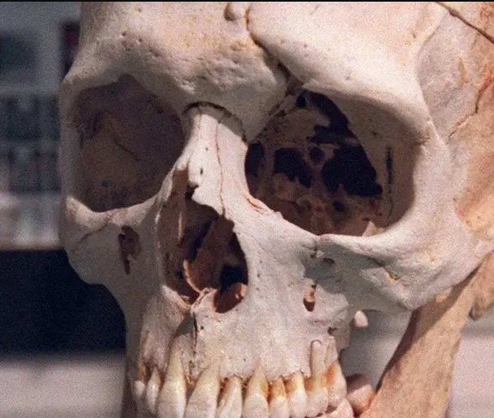 O cr�nio de Gage (foto) integra hoje a cole��o de um dos museus da Escola de Medicina de Harvard, nos EUA � Foto: Getty Images via BBC