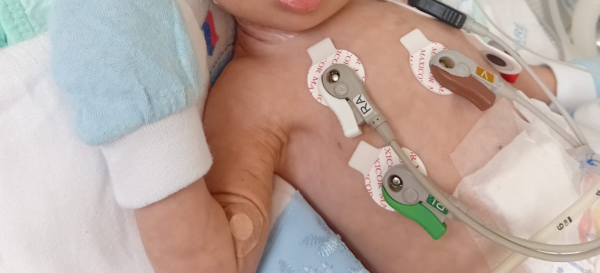 Bebê de 5 meses com síndrome de Down aguarda há 10 dias por leito de UTI em Belém