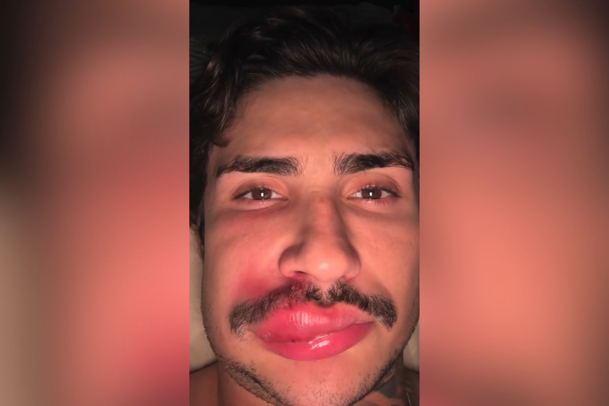 'Zona da morte' do rosto: especialista explica riscos de espremer espinhas após caso de influencer 'Ken de CG'