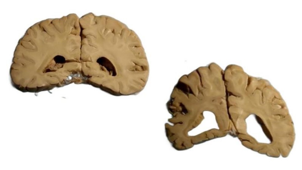 À esquerda, cérebro saudável de uma freira de 90 anos; à direita, cérebro de uma freira de 89 anos com Alzheimer: o cérebro de quem sofreu de Alzheimer é mais leve, porque as células morrem e ficam ocas — Foto: BBC