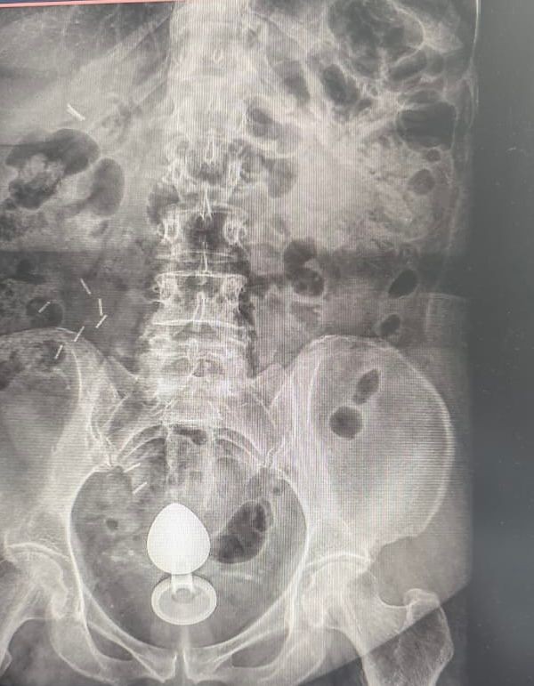 Mulher é internada após plug anal ficar preso no intestino; médicos alertam para riscos no uso do acessório