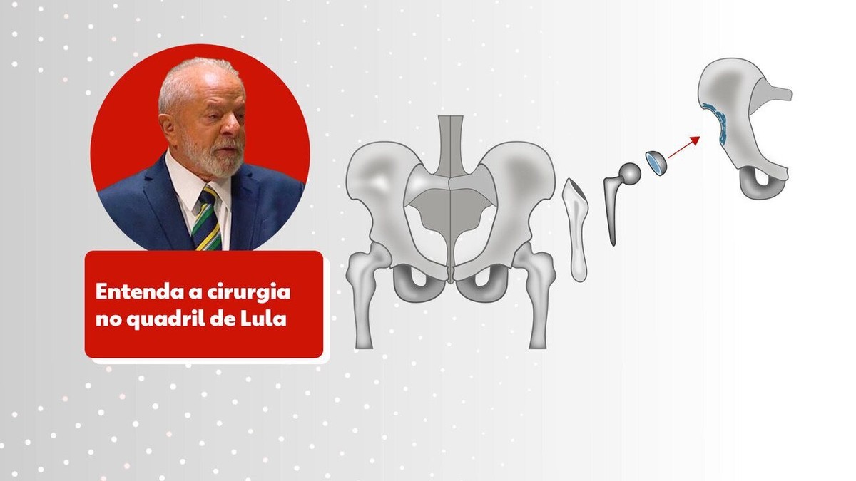 Cirurgia de Lula: Planalto monta esquema para divulgação de informações ...