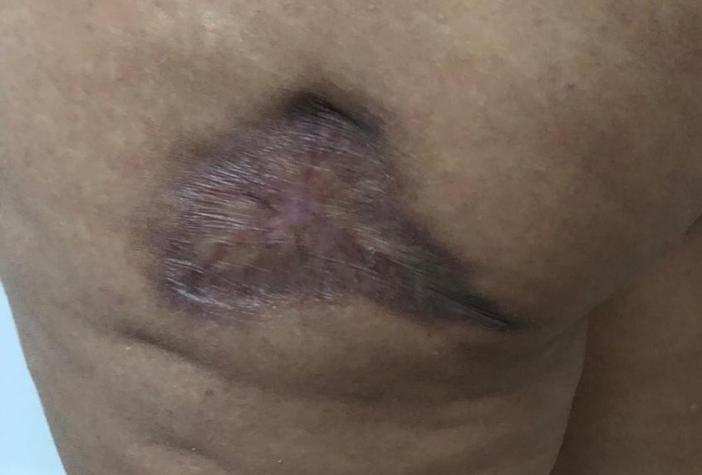 Ferida cicatrizada nos glúteos da cliente — Foto: Arquivo Pessoal