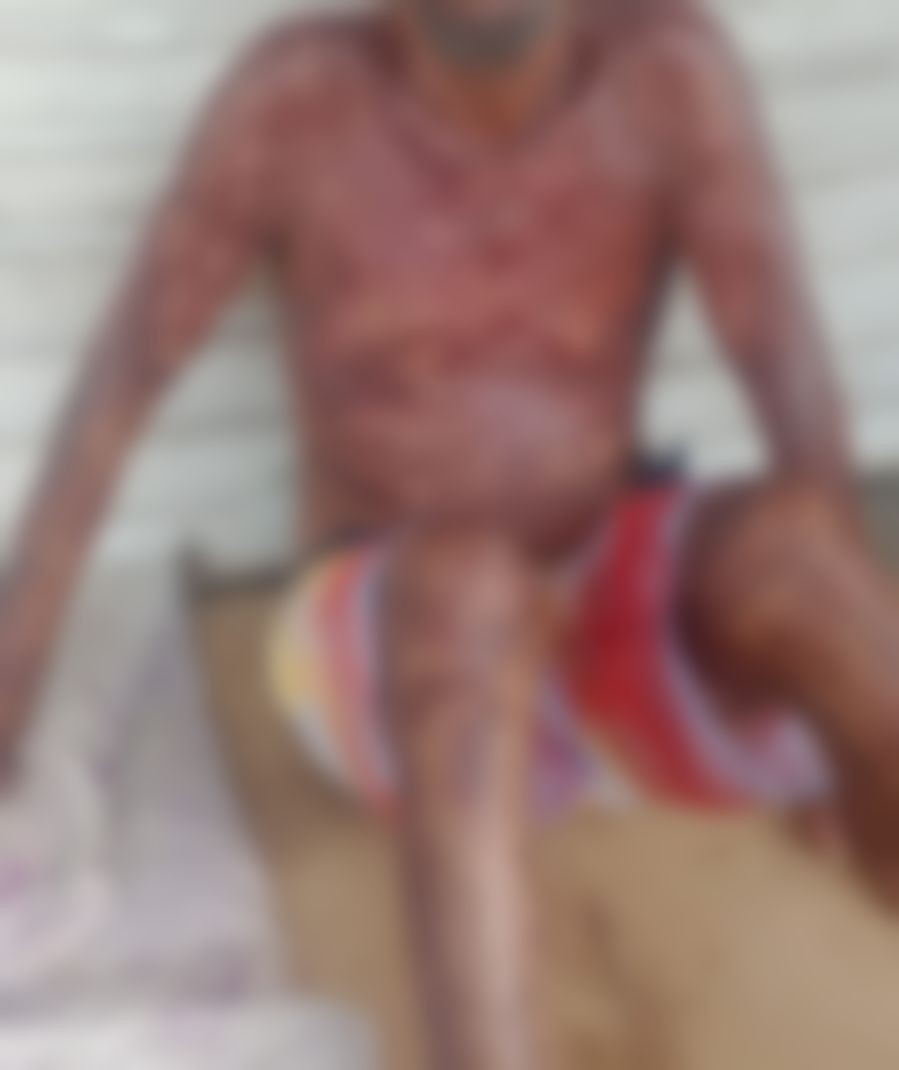 Homem em situação de rua morre após ter 35% do corpo queimado em SE