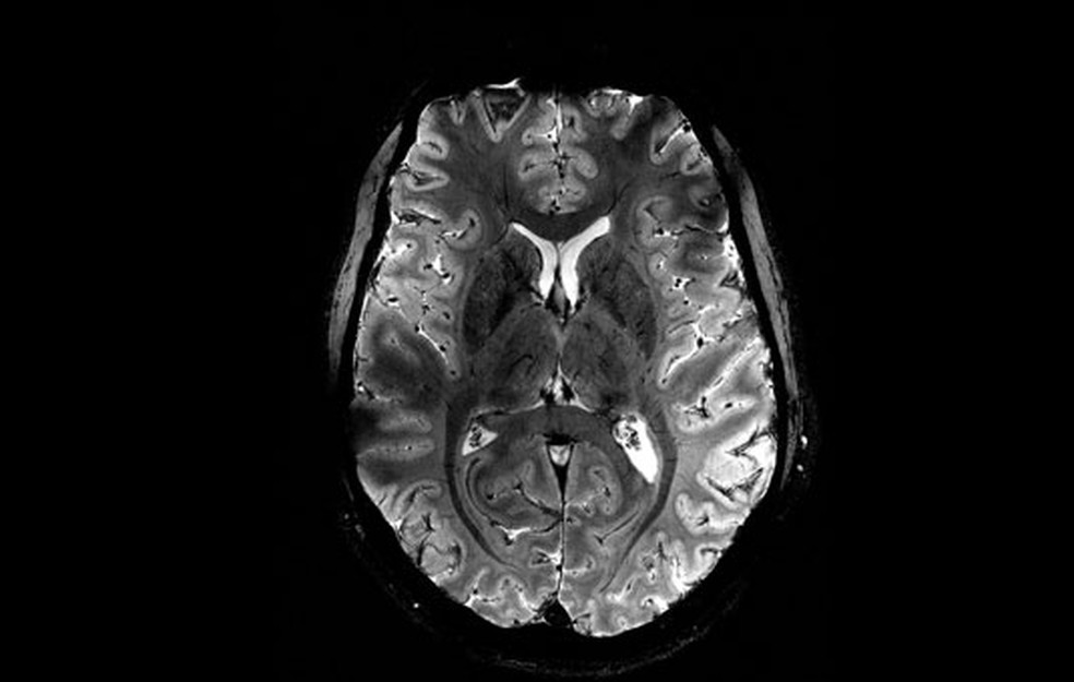 Imagem do cérebro escaneada pelo projeto Iseult. — Foto: Reprodução/Comissão de Energia Atômica da França (CEA)