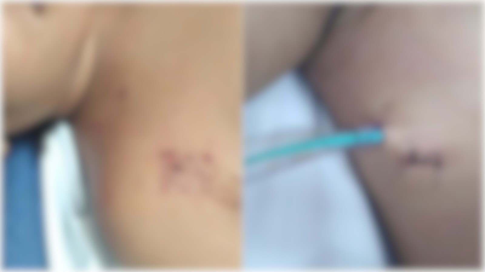 Adolescente grávida sofre nove perfurações com chave de fenda pelo namorado, em Quixeramobim