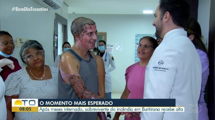 Sobrevivente de incêndio no Distrito Buritirana recebe alta após 5 meses internado