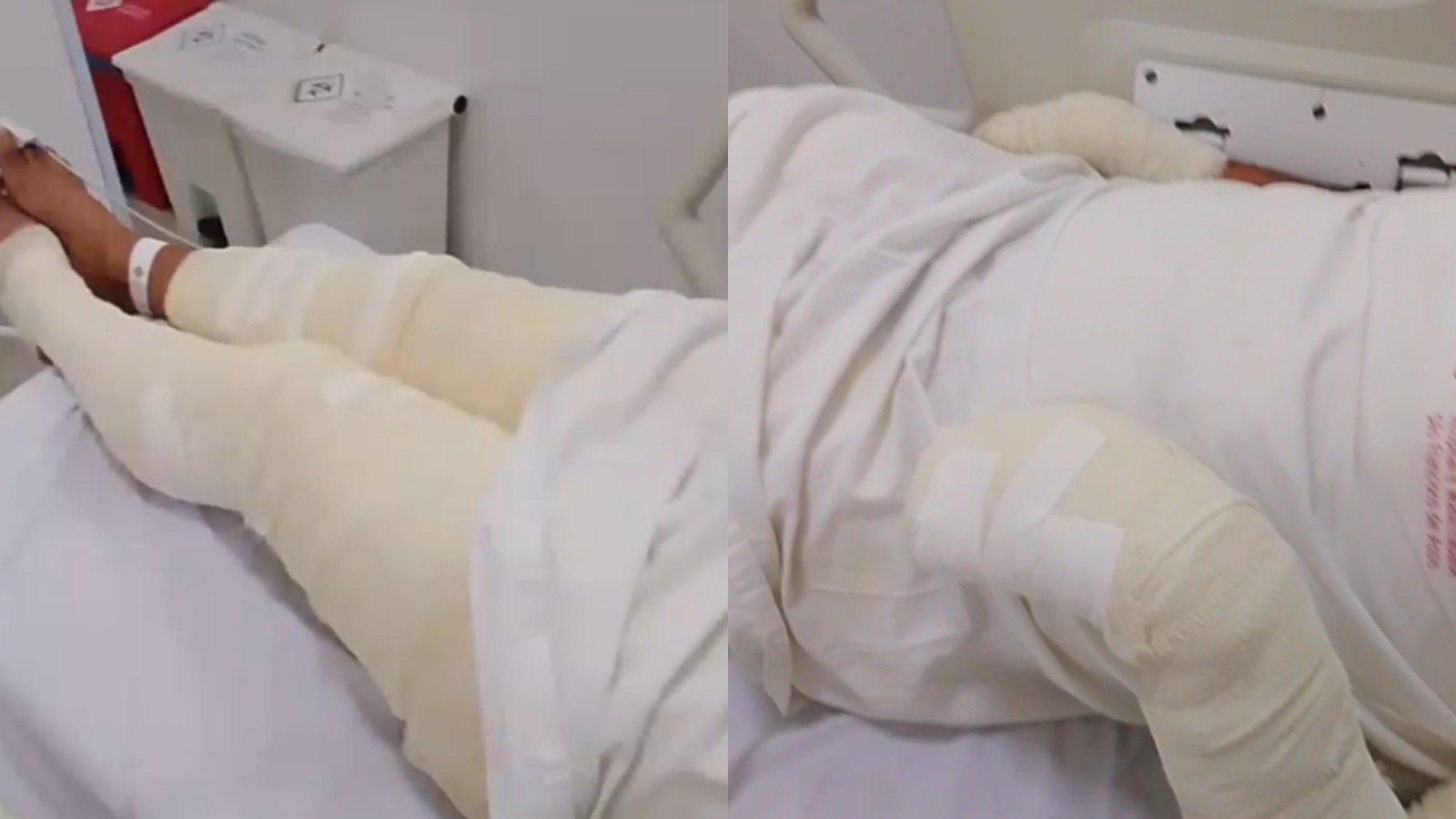 Homem é preso após tentar matar irmão queimado enquanto ele dormia no Ceará