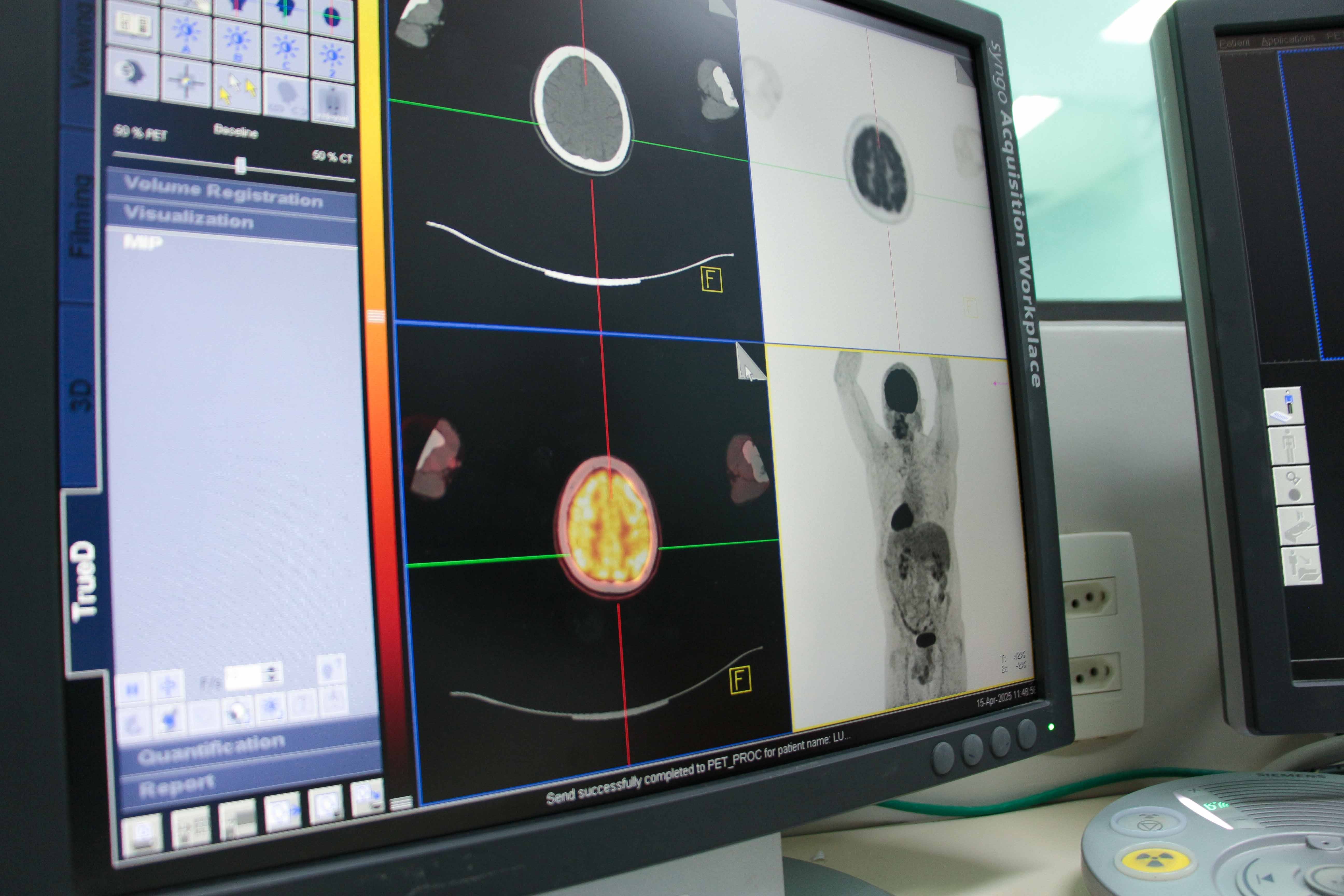 Teranóstica: abordagem que detecta e trata câncer com radiação direto na célula é testada no Brasil