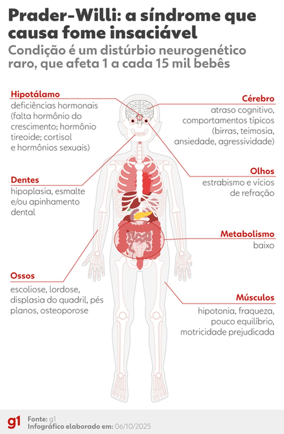 Infográfico: síndrome de Prader-Willi (SPW) afeta 1 a cada 15 mil nascimentos — Foto: g1