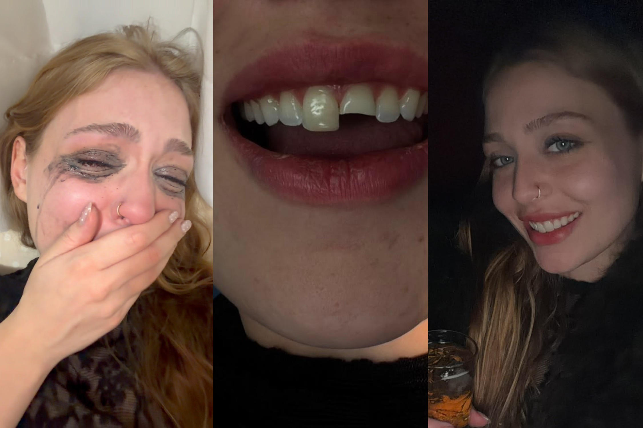 VÍDEO: jovem quebra dente na balada, procura dentista de madrugada e volta para a festa no PR