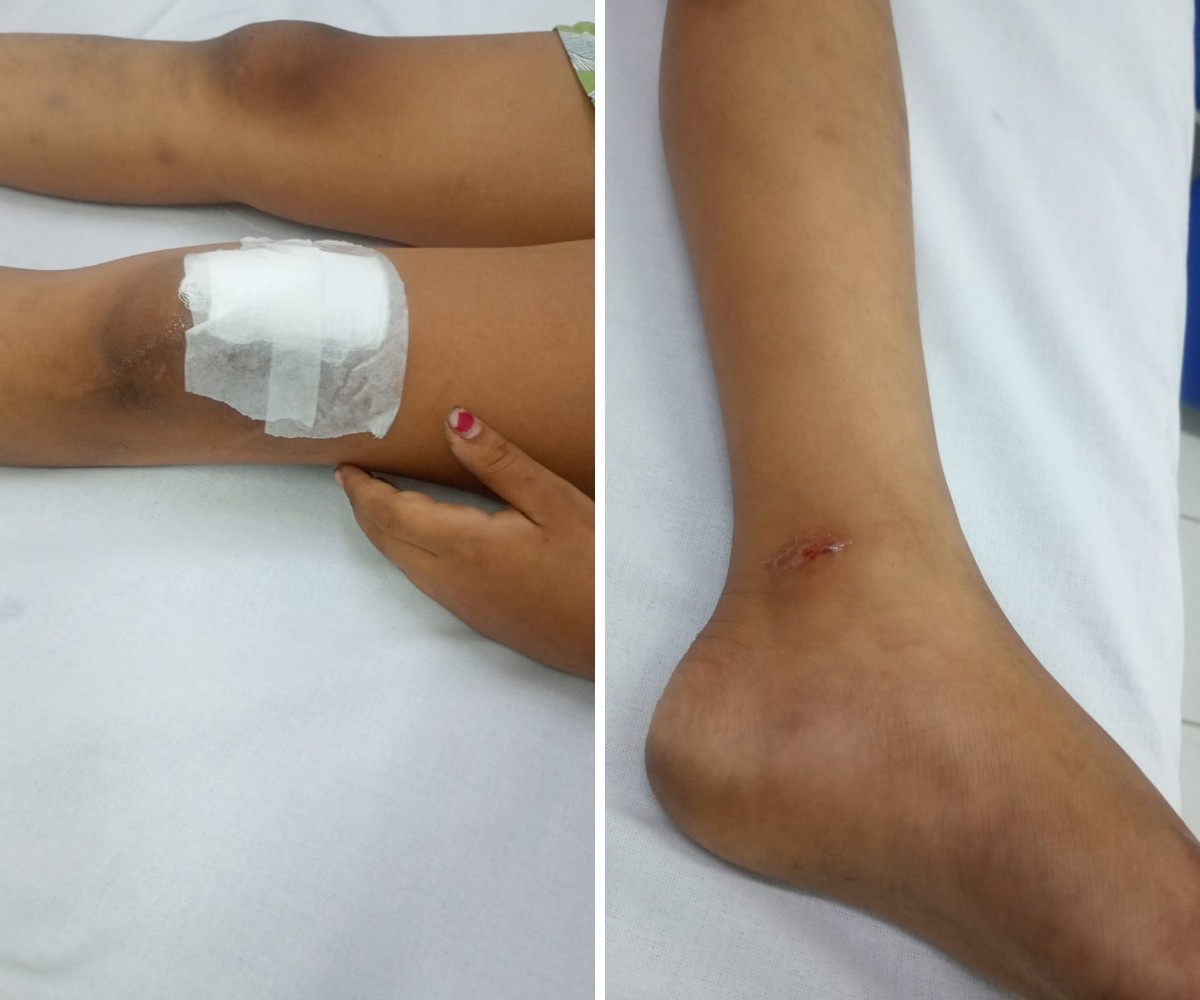 Menina de 7 anos é atropelada enquanto brincava na rua em Hortolândia; motorista fugiu