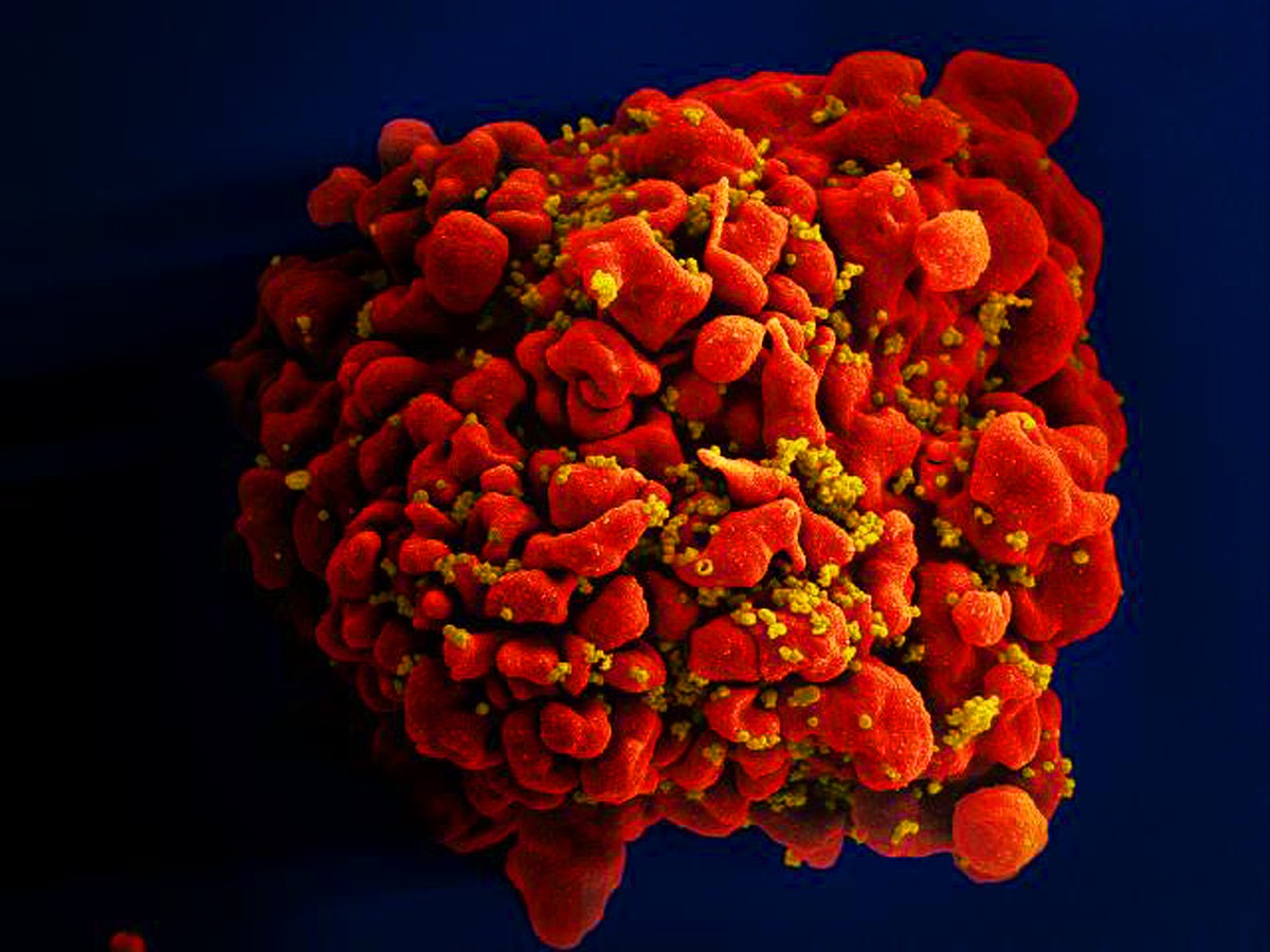 HIV não é sinônimo de aids e tratamento pode garantir vida normal a  pacientes
