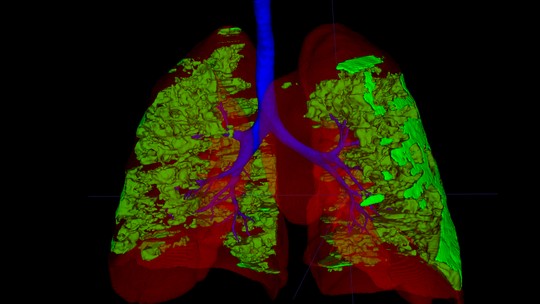 Inteligência artificial desenvolvida na Unicamp mapeia danos da Covid-19 em pulmões infectados