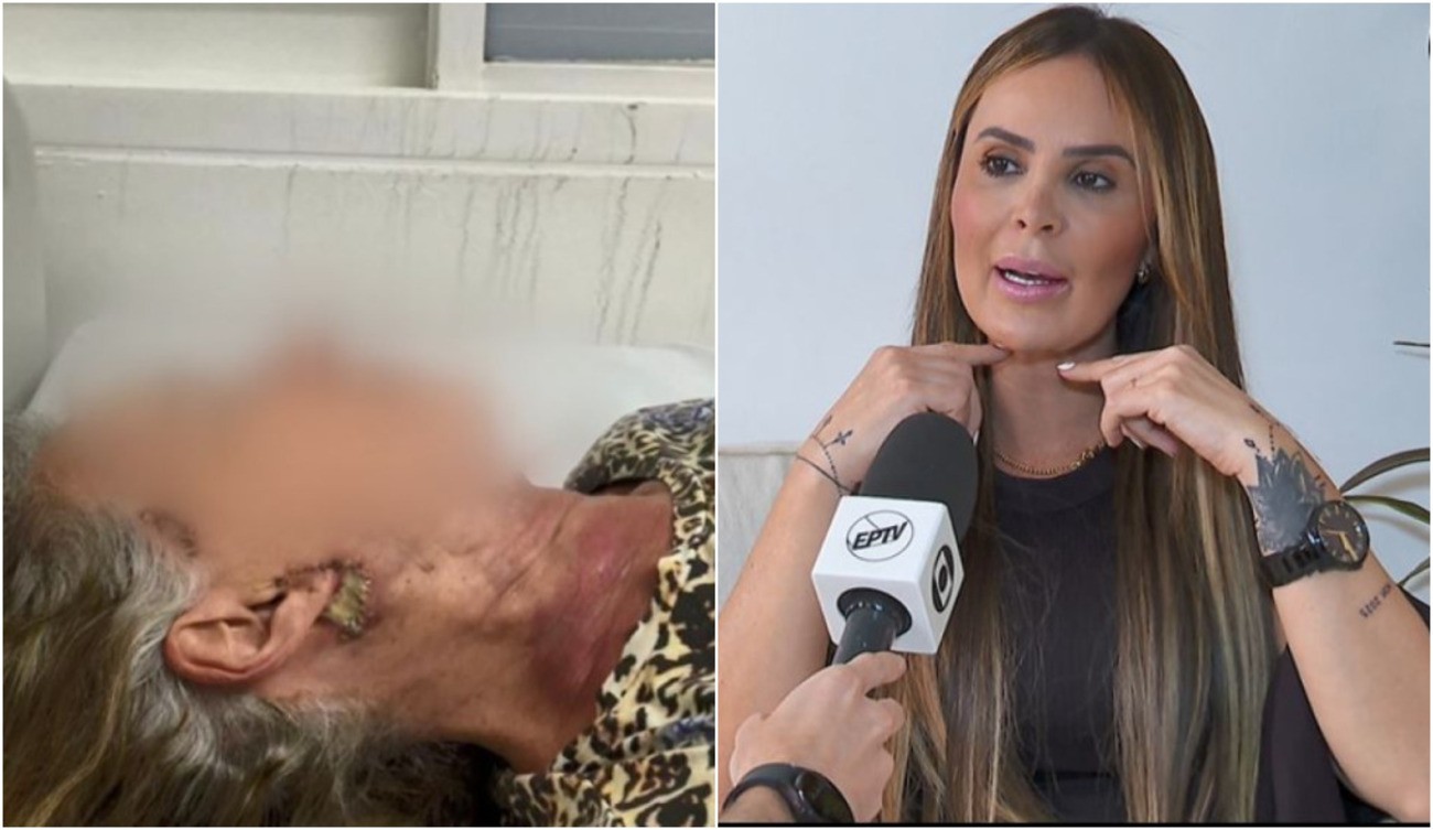 Mãe de influencer é internada em estado grave após procedimento estético com cirurgiã-dentista