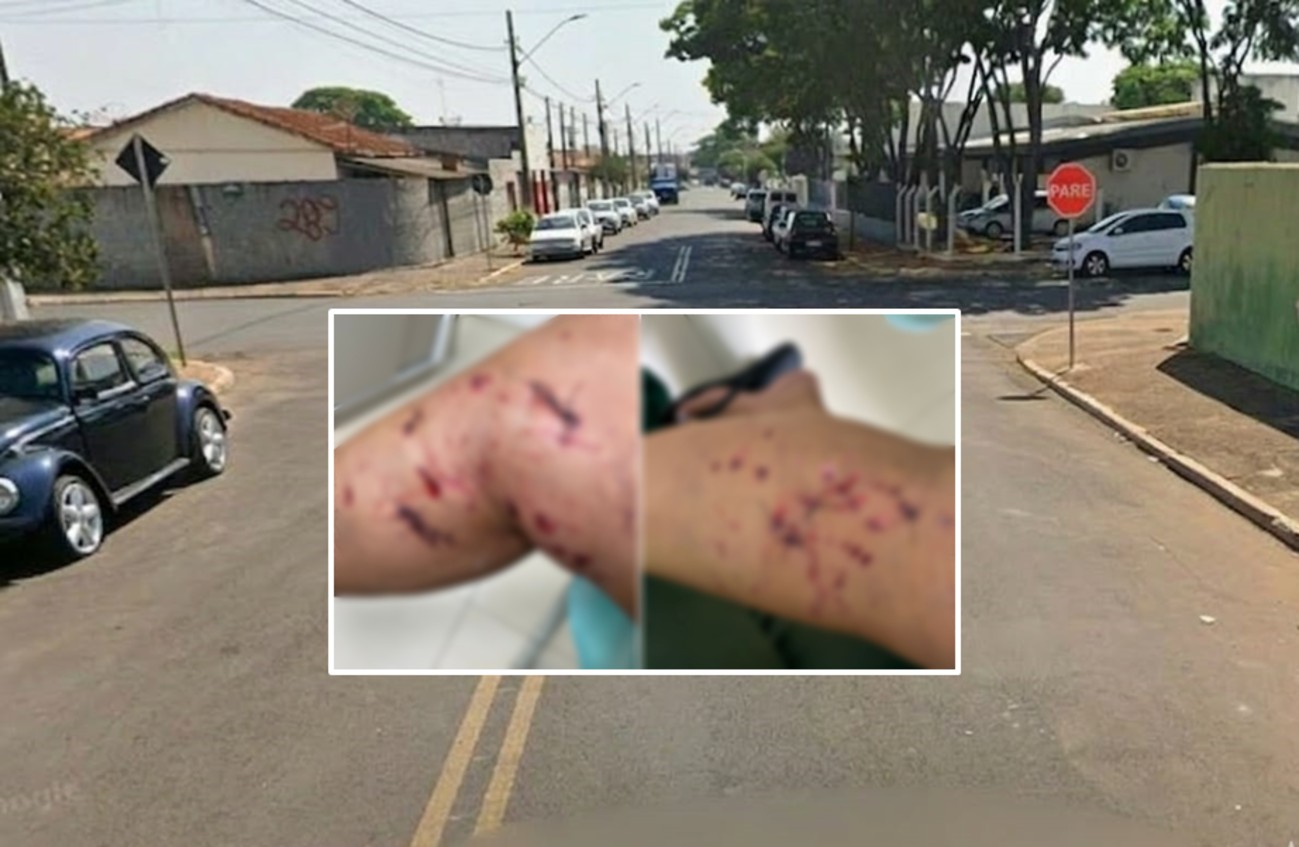 Mulher leva 21 pontos nas pernas após ser atacada por cão pit bull no interior de SP: 'Traumatizada'