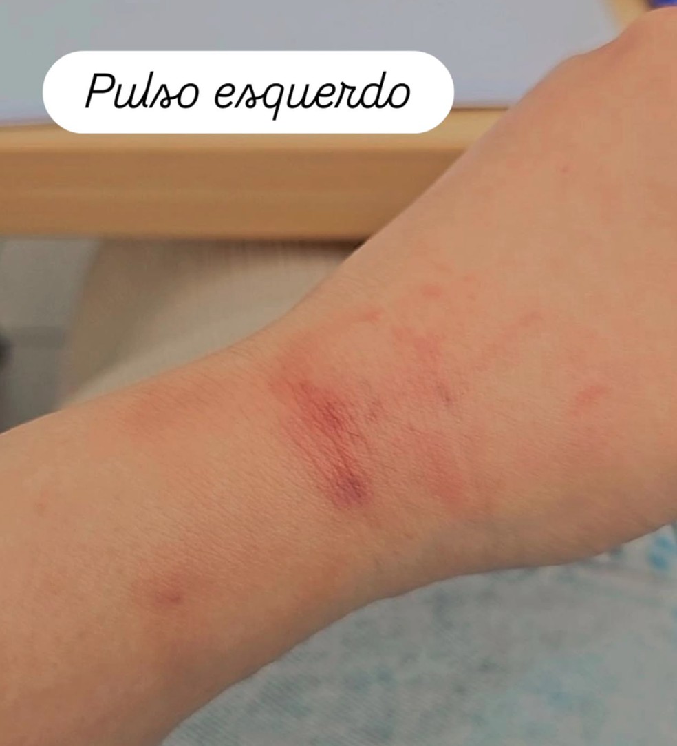 Advogada brasileira mostra hematomas no pulso esquerdo após afirmar ter sido agredido pela polícia no aeroporto de Porto — Foto: Instagram/Reprodução