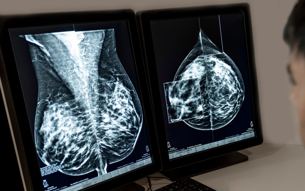 Estudos mostram que, em países onde a cobertura mamográfica atingiu 70%, houve uma queda de cerca de 35% na mortalidade por câncer de mama. — Foto: Adobe Stock