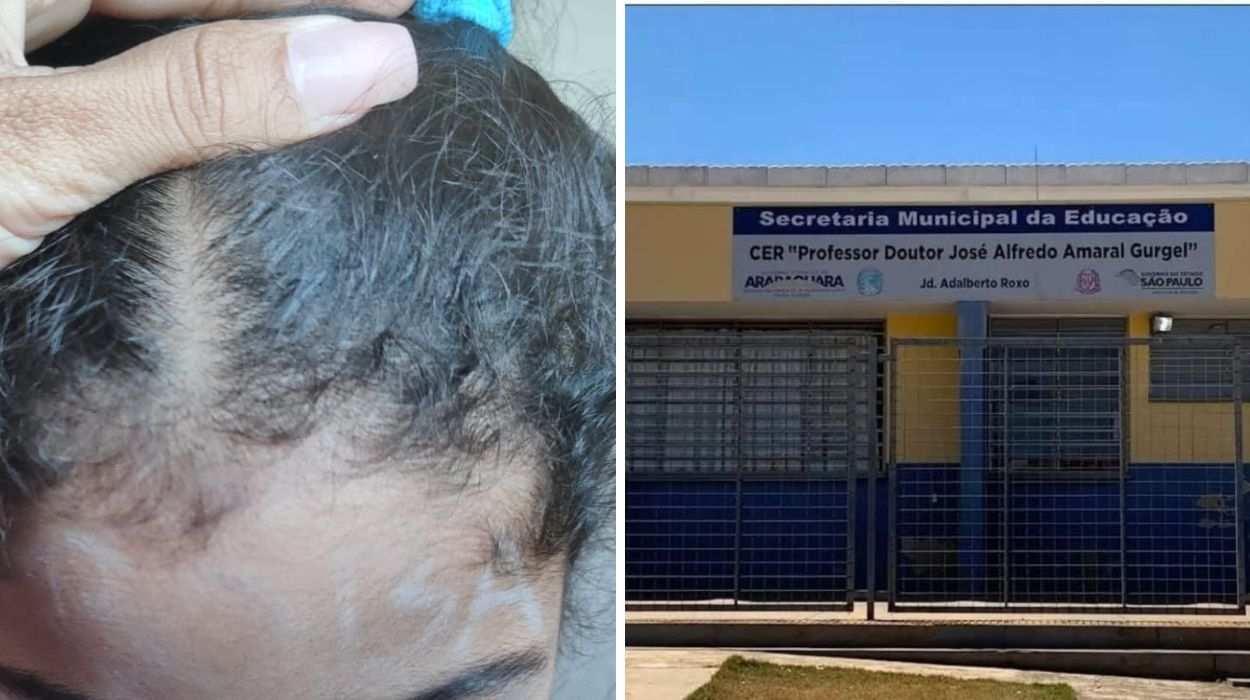 Mãe diz que professora escreveu a palavra 'boba' na testa da filha de 4 anos no interior de SP