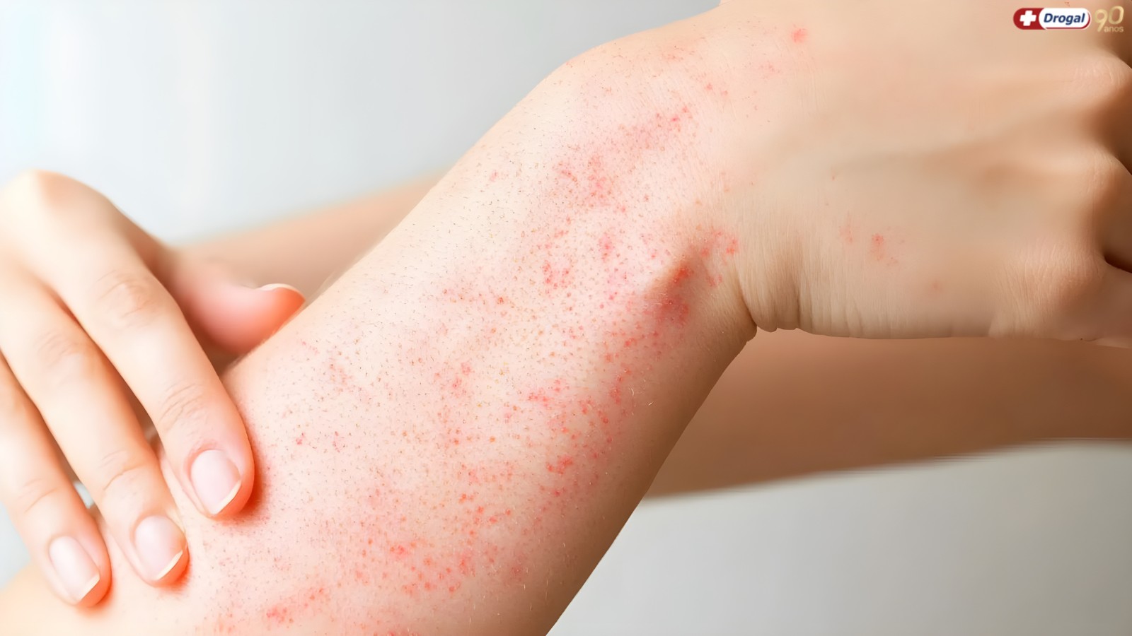 Quais são os tipos de alergia na pele e como seu corpo tenta avisar