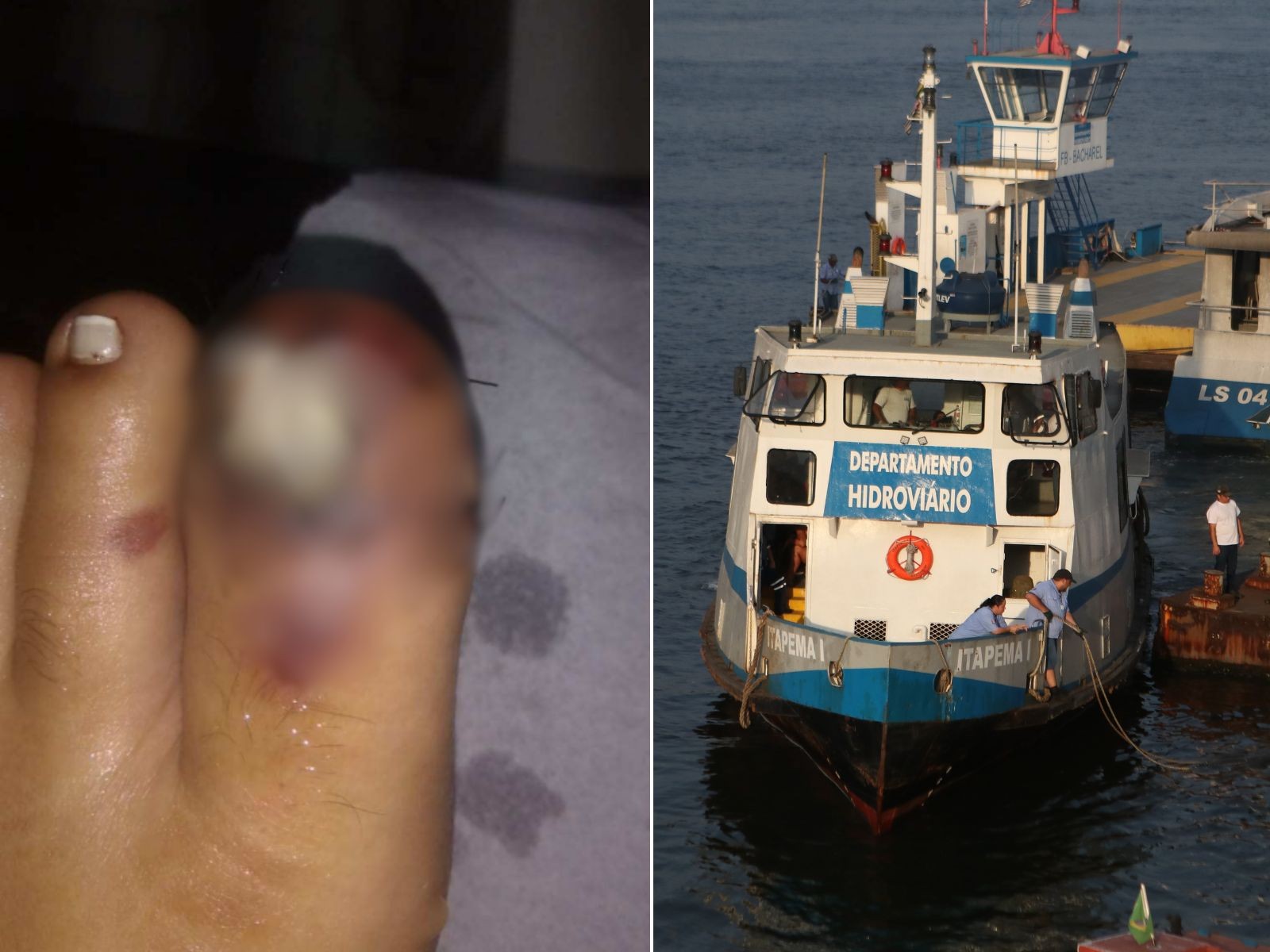 Jovem que teve dedo esmagado em balsa receberá indenização e pensão até os 75 anos