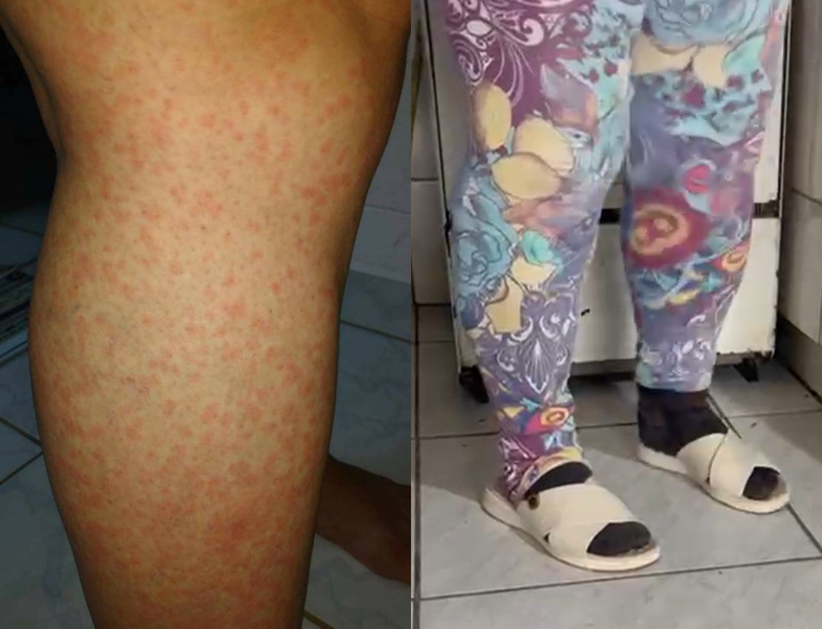 Moradores usam casaco e luvas em calor de 30°C para se proteger de infestação de mosquito em SC: 'Avançam no rosto da gente' 