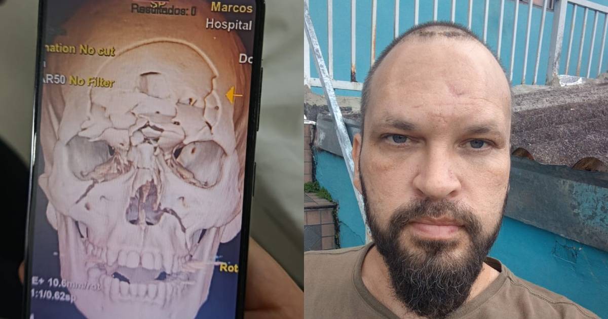 Crânio de motociclista é triturado em batida no Paraná e ele se recupera praticamente sem sequelas: 'Ficou tipo um quebra-cabeça'