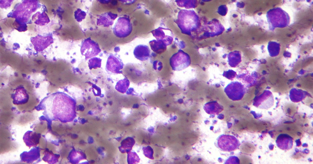 Anvisa autoriza a comercialização do medicamento Columvi para o tratamento de linfoma no Brasil