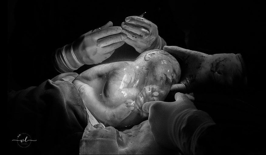 Partos que ocorrem desta maneira não trazem risco para a mãe ou para o bebê, segundo o obstetra — Foto: Vanuza Lolatto/Reprodução 