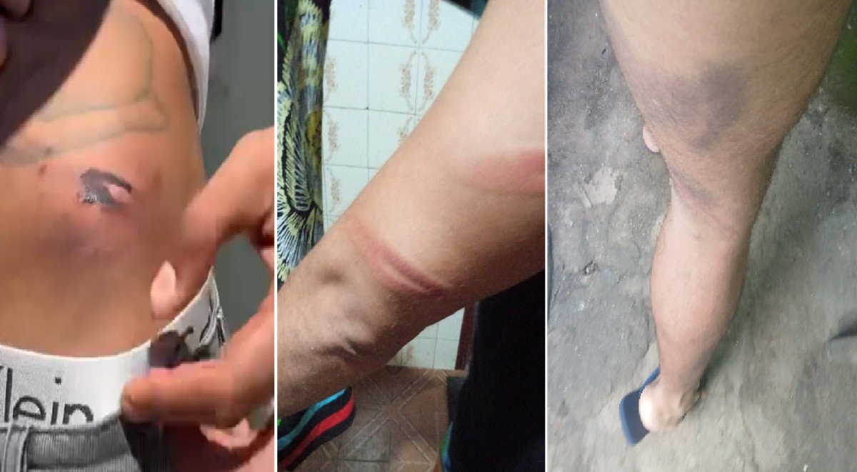 Vítimas mostram marcas de agressão de guardas a clientes e funcionários de bar em Cabo Frio: 'Me espancaram muito até eu ficar quase inconsciente'