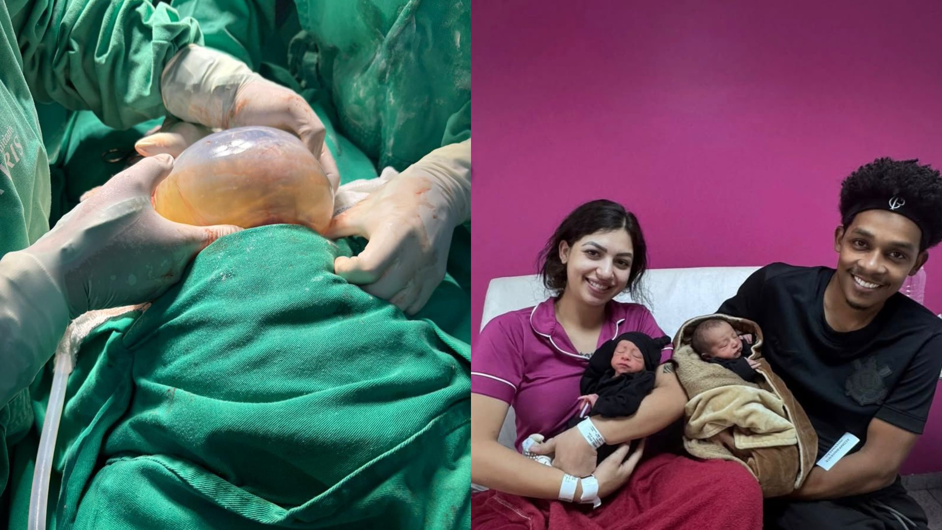 Gêmeo nasce empelicado, e mãe se emociona: ‘Momento lindo e raro’