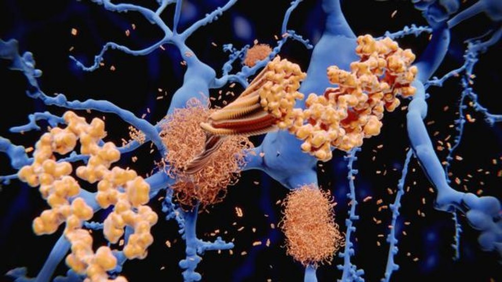 O acúmulo de proteínas beta-amiloide (em amarelo na ilustração) nos neurônios (em azul) é um dos processos por trás do Alzheimer — Foto: GETTY IMAGES