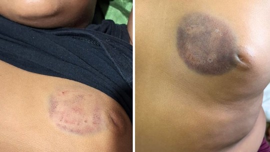 Menino de 7 anos é mordido no peito, agredido por alunos e medicado com  antidepressivo após ataques em escola - Foto: (Arquivo Pessoal)